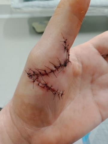 Two surgeries after dog attacks woman and her dog